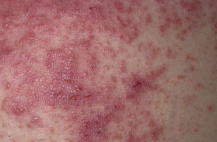 Dermatitis