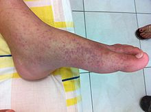 Flu Tulang